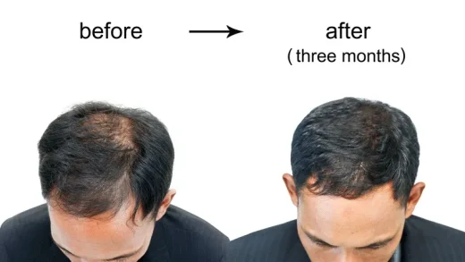 Before Hair Transplant Process