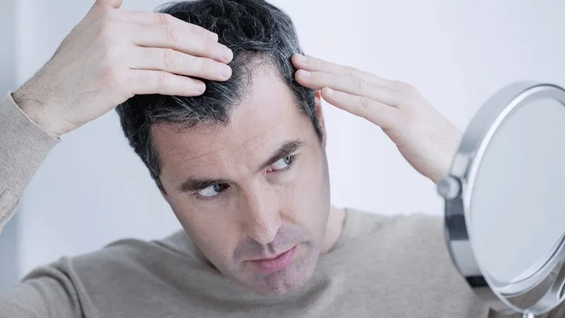 10 Best Treatments For Thinning Hair In Men 2.webp