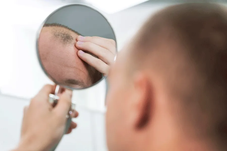 8 Tips To Prevent Swelling After Hair Transplant
