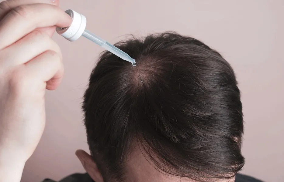 Do You Need To Take Minoxidil After Hair Transplant?