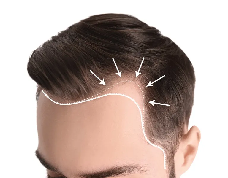 Hairline: Why Is It Important?
