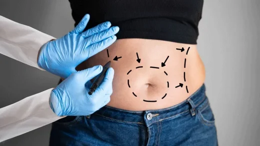 Liposuction Vaser: What is Important to Know?