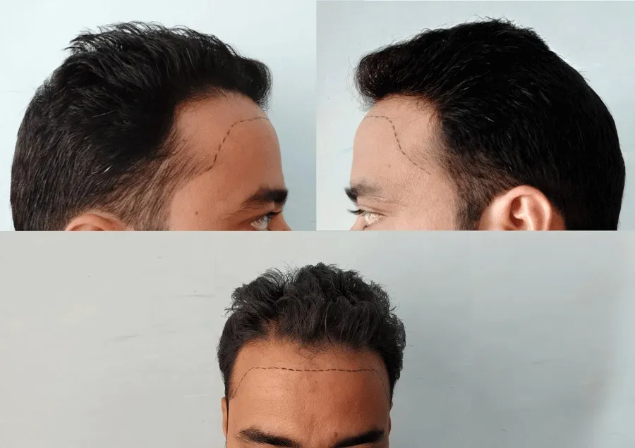 Wrong Hair Transplant: How To Fix?