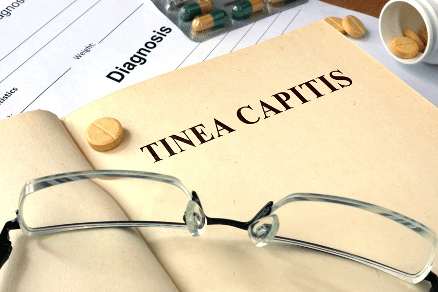 Tinea Capitis: Ringworm Hair Loss