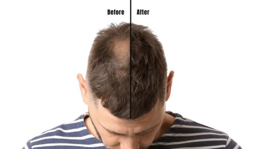 When Does Transplanted Hair Take To Growth? - Erdem Clinic