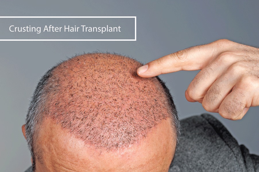 When & How Can I Remove Crusting After Hair Transplant?