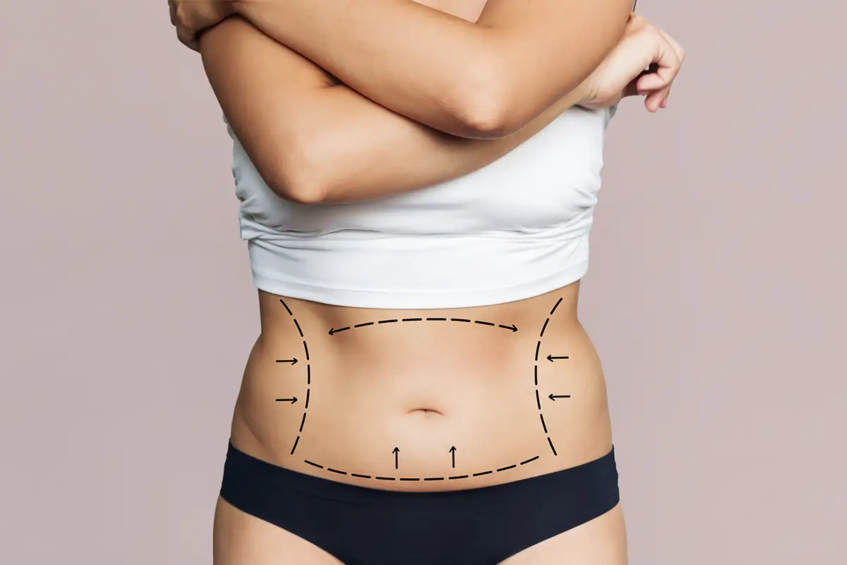 Is Liposuction the Answer to Stubborn Fat?