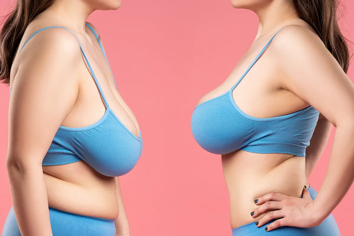 Recovery Tips After a Breast Reduction