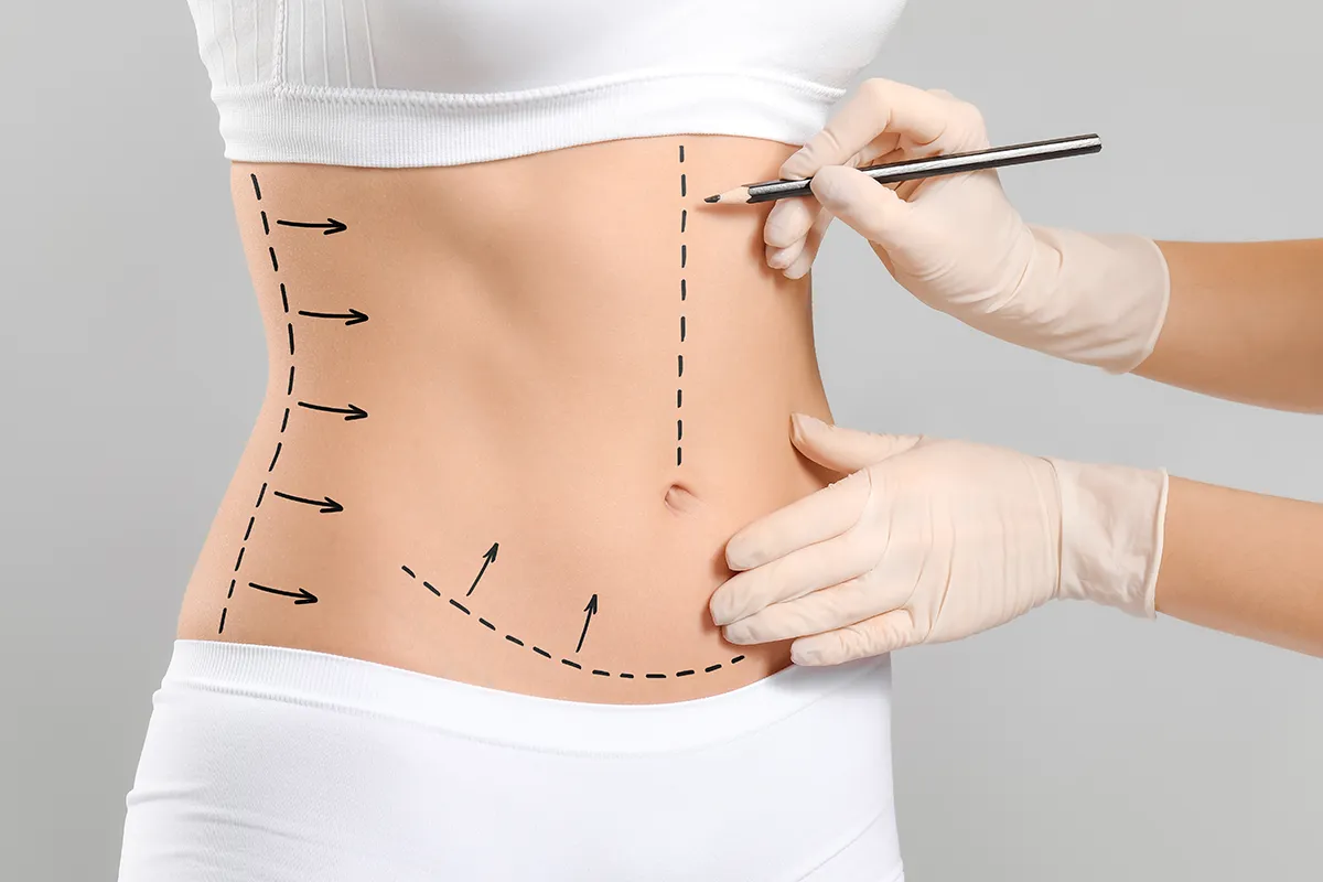 Tips for a Fast Recovery After Abdominoplasty